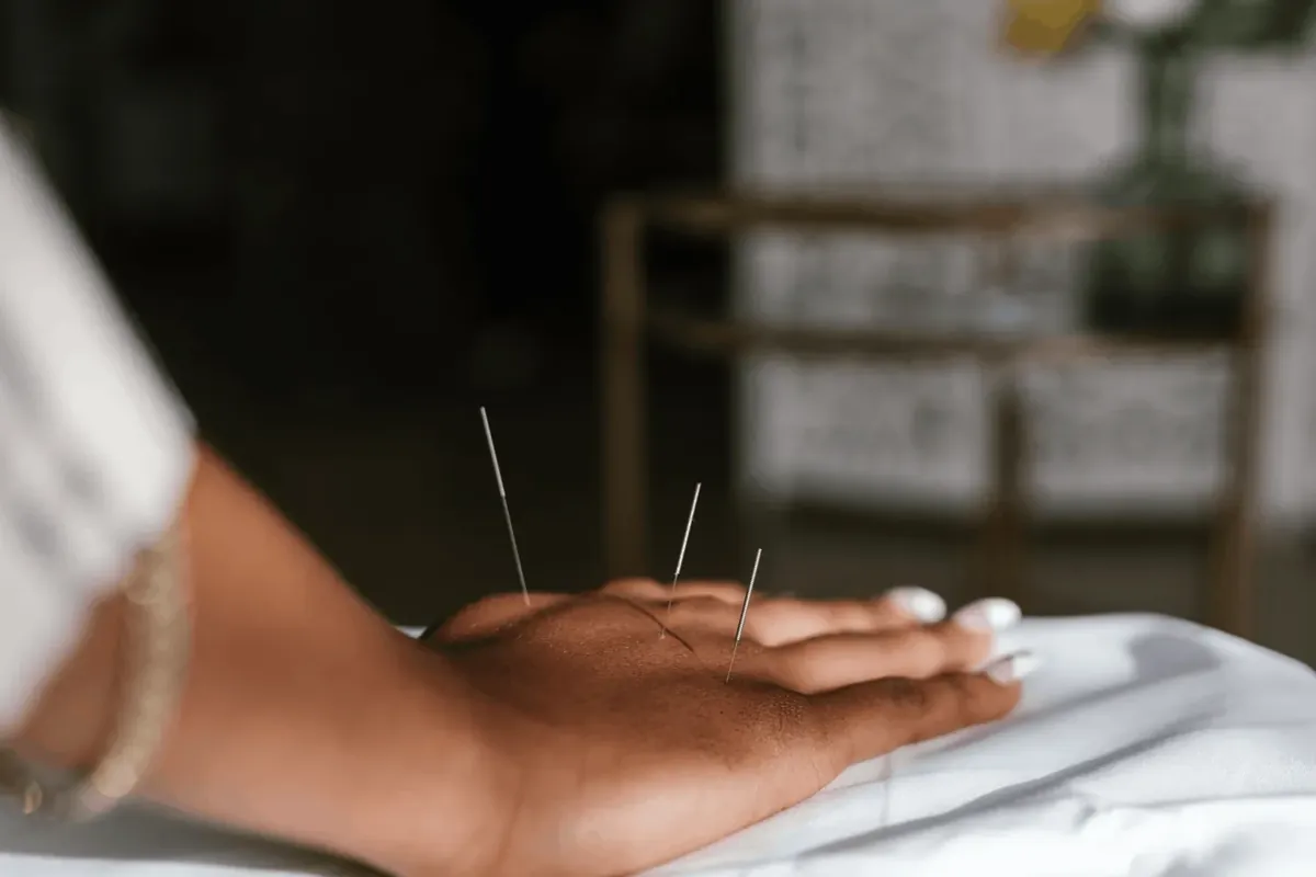 Acupuncture needles placed in the hand to ease arthritis joint pain