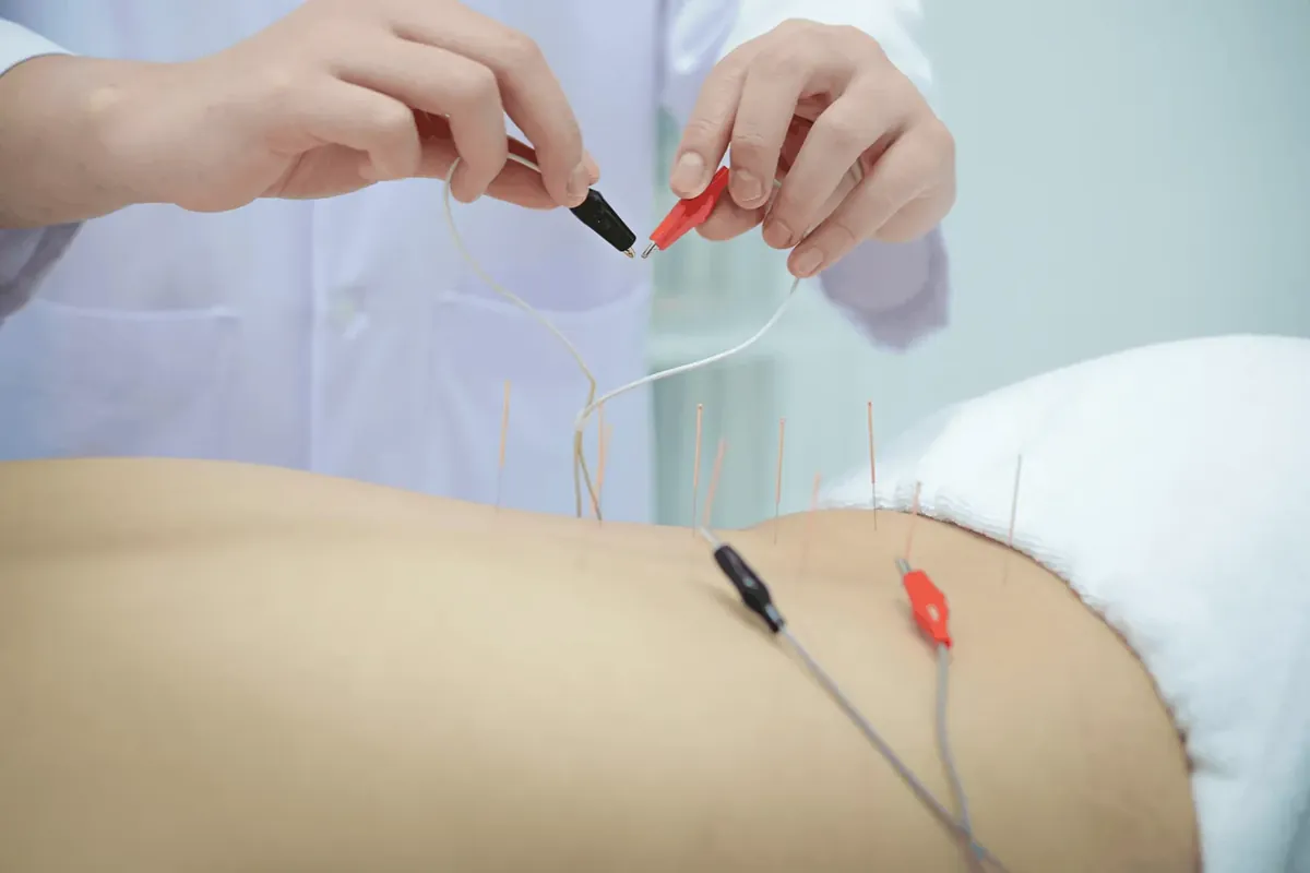 Electro-acupuncture treatment with gentle electrical stimulation on the needles